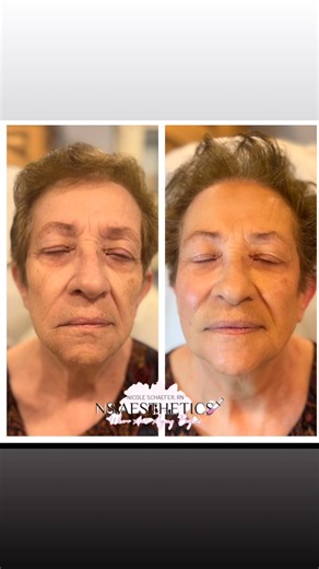 Nicole Schaefer, RN,LME | ✨ Ready to LEVEL UP your PDO Thread game? ✨ Join Nicole Schaefer, RN, LME — aka @threadmasternicole_cherryhill — founder of... | Instagram