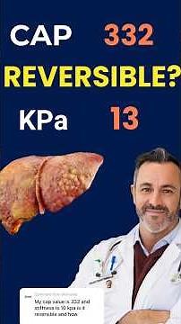 Your Fibroscan score explained #fibroscan CAP 332 KPA 13 - what to do?
