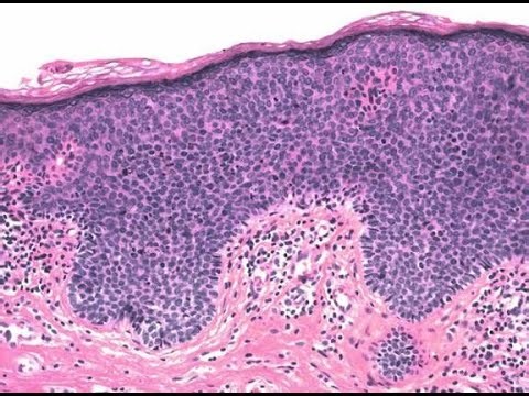 Vulvar intraepithelial neoplasia VIN; precancerous condition of the vulva