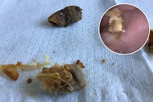Medic discovers giant lump of dried wax matted with hair blocking man's ear