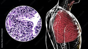 A human body revealing smoker's lungs, 3D animation and light micrograph footage. Smokers' lungs exhibit discoloration, tar deposition, and respiratory damage due to chronic exposure to tobacco smoke.