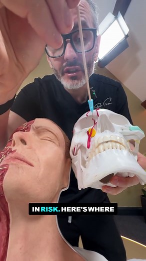Nasolabial Fold Injection: Safer Lateral or Medial?