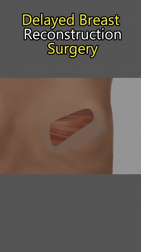 Delayed Breast Reconstruction Surgery 3D Animation