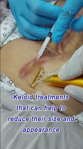 Exploring Keloid Scars: A Secure Path at Dr. Shaista Lodhi's Clinic #KeloidScars