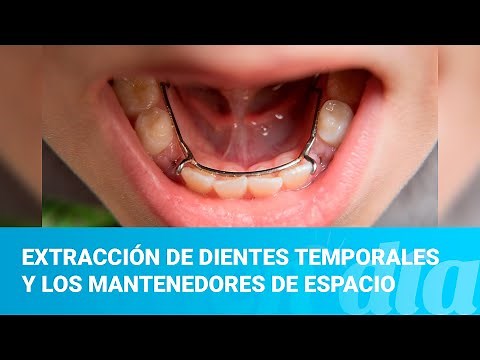 Extracción de dientes temporales y los mantenedores de espacio