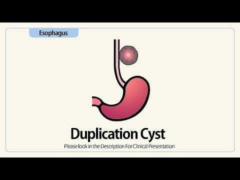 Linear EUS: Duplication Cyst