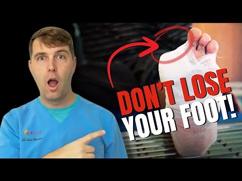How to Prevent Losing Your Foot from Diabetes in 2025 | Expert Podiatrist Advice