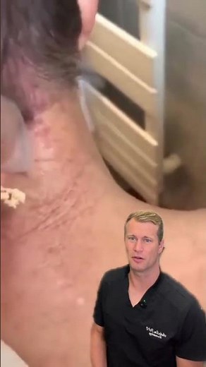 Silly string cyst!! #cyst #fyp #pimple #satisfying #pimplepop #satisfyingvid #gross #skin #pus