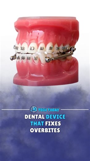 The Herbst appliance is a dental invention that fixes overbites without surgery. It uses small metal rods that connect to the teeth and gently move the lower jaw forward over time. credits: tiredbutready /TT zairamonzonez /IG #technology​ #science​ #interesting​ #dentist #dentaldevice | Tech Today