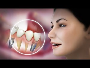 Dental Implant | How is An Amazing Gold Dental Implant Surgery Done | Tooth Placement