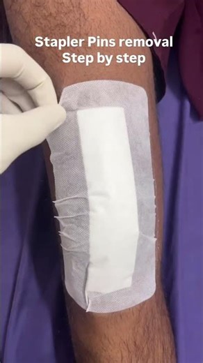 Staple pin removal step by step! #surgery #doctor #stapler #tkr #suture