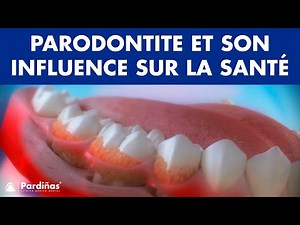 La parodontite et son influence sur la santé ©