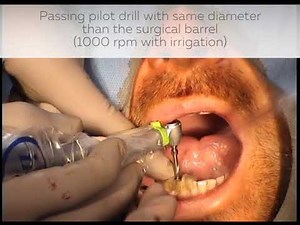 Mandibular and maxillary implant placement with associated digital surgical guide