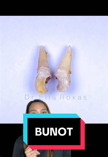 Understanding Root Canal Treatments for Better Dental Health