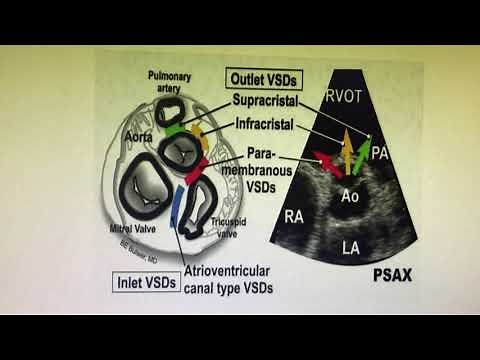Types of VSD in short axis view