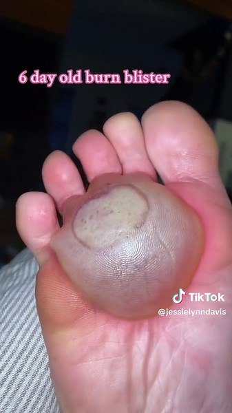 My insane, painful burn blister. Unpopped. 6 days old. #blister #burn #willitbreak #medicaltiktok #foot #ingury