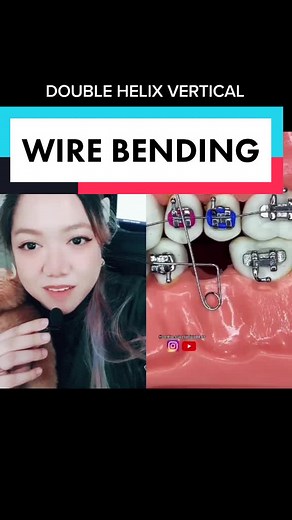 Achieving Perfect Smiles with Vertical Braces and Double Helix Loop