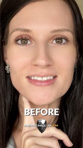 Achieving My Dream Smile with Snap-On Veneers