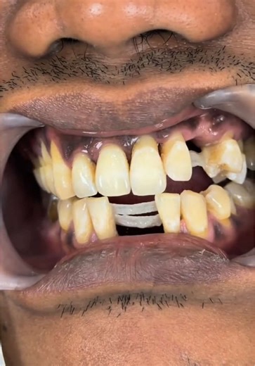 Tambalan Splinting 3 gigi beserta Before dan Afternya. #fyp #pyfツ #fypviral #rumahgigidenpasar #salongigidenpasar