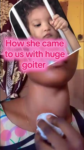 Natural Goiter Treatment Success Story