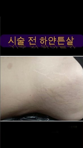 미라젯 쥬베룩 튼살 시술 | 하얀 튼살, 임신튼살 튼살전후 미라젯후기 #shorts #튼살 #미라젯 #쥬베룩