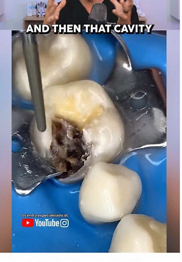What a Cavity Really Looks Like: Insightful Dental Care