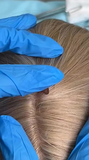 Tick Removal Procedure on Scalp with Professional Care