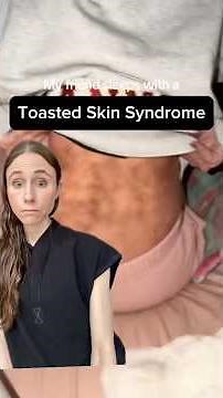 Dermatologist Reacts to Toasted Skin Syndrome (Heating Pad Burn)