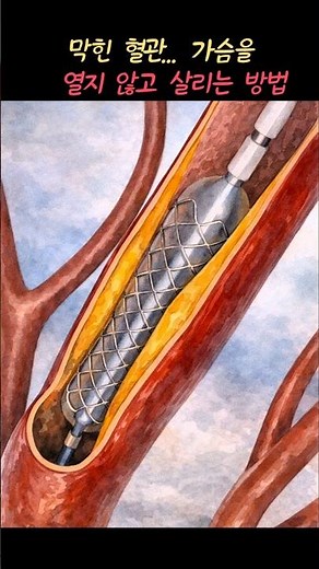 Stent Procedure to Open Blocked Blood Vessels | Cardiovascular Treatment