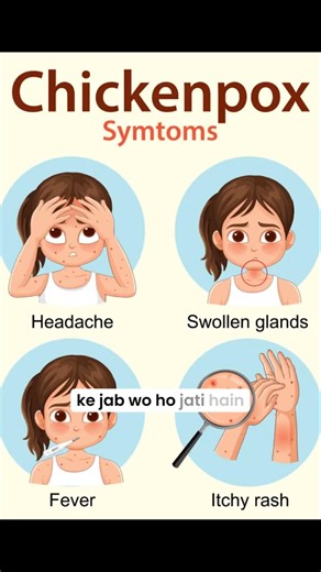 Chicken Pox Treatment