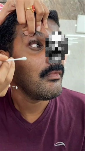 Dr M.Nirumal Khumar(Neuro nerd) on Instagram: "Corneo-mandibular reflex was initially described in comatose patient who have bilateral cortical dysfunction.. It was later extrapolated to diseases like ALS. ALS is known for its absence of eye signs. But this is one exception. It's presence suggested b/l corticobulbar dysfunction. WICK of cotton is used as opposed to wisp which is normally used to check corneal reflex. Because a stronger stimulus is necessary. The response is deviation of mandible