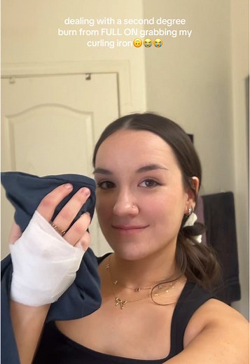 Dealing with Curling Iron Burns: My Personal Experience