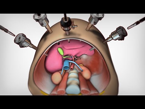 Robotic Liver Segment 6 Resection | TVASurg