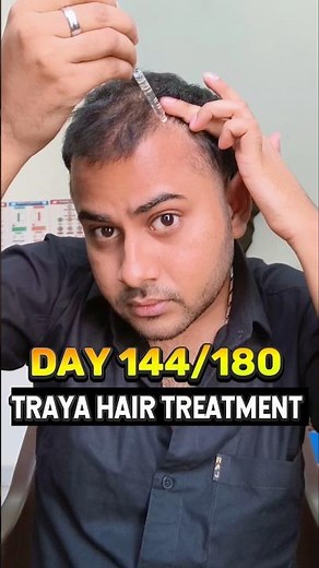 Day 144/180 Traya Hair Regrowth treatment review