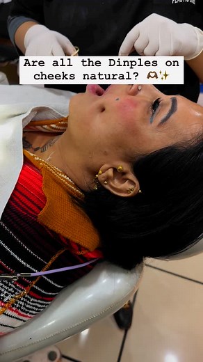 Dr. Swati Mittal on Instagram: "Dimple creation, also known as dimpleplasty, offers several advantages for those seeking to enhance their appearance and boost their confidence. Here are some key benefits: 1. Enhanced Aesthetics Dimples are often associated with beauty, charm, and youthfulness. They can make your smile more captivating and unique. 2. Customized Results The procedure allows for personalized placement and depth of dimples, ensuring they complement your facial structure naturally. 3