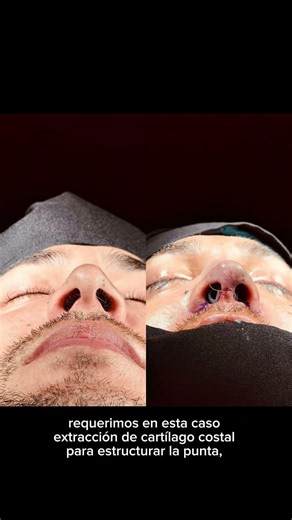 Septorinoplastia estructurado con injerto Costal , el paciente presentaba desviación del septo