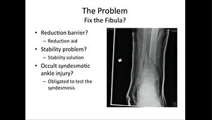 Extraarticular Distal Tibia Fractures OTA 43.A