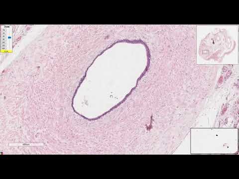 Vas deferns in spermatic cord (Normal histology)