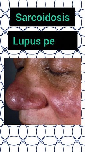 chronic granulomatous disease and dermopathy#medicine#medstudent #medicalstudent#skin#dermatology