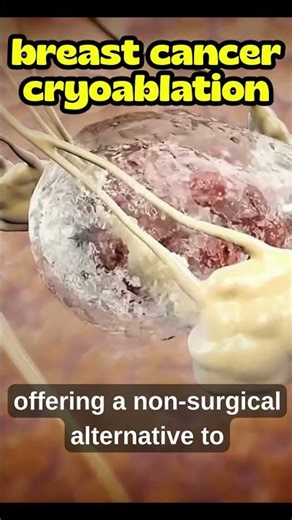 Cryoablation for Breast Cancer