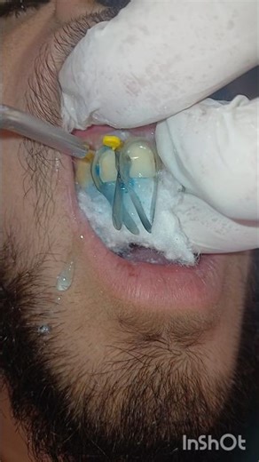 Class V composite restoration for anterior and posterior teeth #shorts #dentist