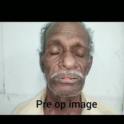 Ca lower lip ( T2N0M0) - Wide local excision with Johansen step ladder flap with Bilateral SOMND.