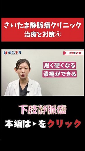 【下肢静脈瘤】治療と対策④ #下肢静脈瘤 #足がつる #こむら返り