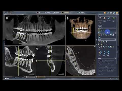 Mastering Endodontic Precision: Sidexis 4.3 Tutorial on Endo Layout