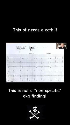 Wellens Syndrome = biphasic or deeply inverted T waves in V2-3, plus a history of recent chest pain now resolved. It is highly specific for critical stenosis of the left anterior descending artery (LAD) This is not a non specific st t wave change!! Beware of this finding! ☠️ #physicianassociate #physicianassistant #rn #pastudent #nursepractitionerstudent #nursepractitioner #medstudent
