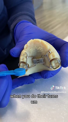 HOW TO TURN A RAPID PALATAL EXPANDER: 👊🏼💥 A rapid palatal expander (RPE) is commonly used with our phase one patients to prevent malocclusions by widening the upper jaw. 😁 Sometimes, the turns can get a little tricky once you get home. Use this guide as a reminder, or feel free to call our office at (402) 592-3200 with questions! 🤗 #hawleyorthodontics #hawleysmiles #smilebekinddogood #expander #phaseone #braces #papillionne #papillionorthodontist #omahaorthodontist