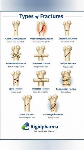 11 Types of Bone Fractures Explained in 60 Seconds 🦴 | मेडिकल Knowledge You Must Know! | Rigidpharma
