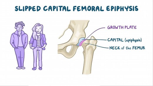 Video: Slipped capital femoral epiphysis - Video Explanation! | Osmosis | Osmosis
