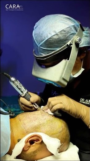 What a hair transplant actually looks like up close #hairtransplant #fue #hairrestoration