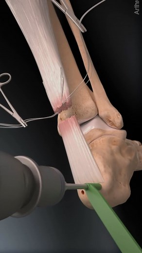 35M views · 5.3K reactions | A step-by-step visualization of Achilles tendon reconstruction using the SpeedBridge™ system. The suture passes through the tendon without knots and is anchored into the heel bone, ensuring a strong and stable repair. This technique promotes faster recovery and reduces the risk of complications. Could this method change the way Achilles tendon injuries are treated? Share your thoughts in the comments. Credit: @arthrexmeded | Plastic Touch | Facebook